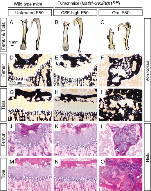 Intraventricular Vismodegib does not affect microscopic bone morphology. A–C: Overview sections of von Kossa stained femur and tibia bones show no aberrations und untreated wild type mice (A) and CSF-high treated tumor mice (B) but shortened bones in orally treated tumor mice (C). D-I: At 100× magnification, von Kossa stained sections of growth plates of orally treated mice show aberrant mineralized tissue, while growth plates of untreated wild-type siblings and CSF-high-treated mice show no irregular mineralization. J–O: Corresponding H&E stainings show highly disturbed columnar organization after oral treatment, while growth plates of untreated wild type siblings and CSF-high treated mice are intact. At least four animals per group were investigated. Representative images are shown.