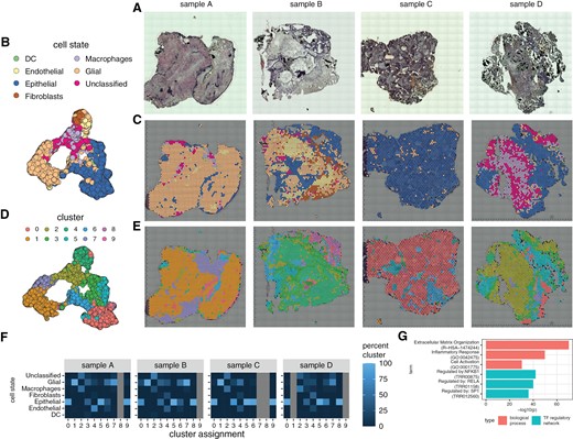 Spatial transcriptional heterogeneity in adamantinomatous craniopharyngioma tissue. (a) Brightfield microscopy images for the four spatial gene expression samples acquired. (b, c). UMAP representation of spatial gene expression data annotated for inferred cell state with annotations overlayed on microscopy images. (d, e) UMAP representation of spatial gene expression data annotated for cluster ID with annotations overlayed on microscopy images. (f) Heatmap is stratifying the percentages of cluster cell state composition per patient. Note that all percentages are per column; a cluster typically corresponds to one cell type. (g) Enriched biological processes and transcription factor (TF) regulatory networks for spatially variable genes in ACP tissue.