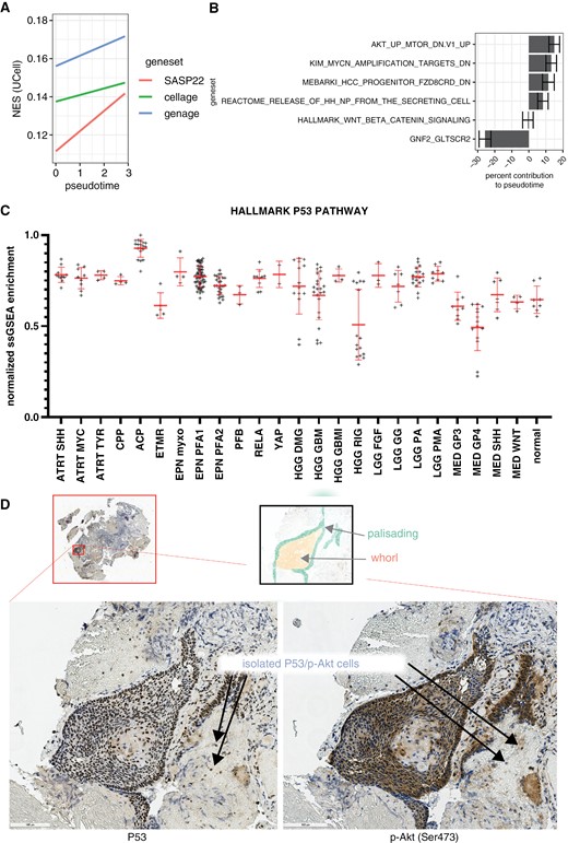 Pseudotemporal model and bulk RNA-seq enrichment. (a) Linear models of SenMayo, CellAge, and GenAge normalized enrichment score (NES) on pseudotime. (b) Significant gene sets that help explain pseudotemporal development. (c) Normalized ssGSEA enrichment of MSigDB HALLMARK P53 Pathway across pediatric brain tumors. Immunostaining of P53 (d, left) and p-Akt (d, right) in ACP primary tumor tissue reveals P53 and p-Akt colocalization in densely packed clusters and sparse isolated cells.