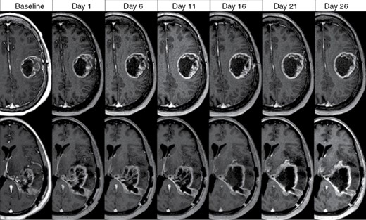 Tumor dynamics in 2 patients with MGMT-promotor unmethylated glioblastoma treated with concurrent chemoradiotherapy (60 Gy in 30 fractions) with contrast-enhanced T1w MRI acquired weekly demonstrating progressive increase in enhancing tumor/cavity during the treatment course.