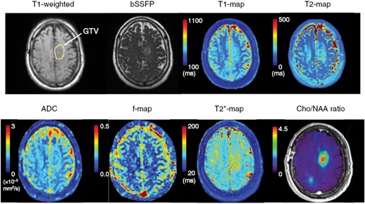 Example daily multiparametric MRI protocol on a 0.35 T MR-Linac. The default imaging type on the system is balanced steady state free precession (bSSFP), which is fluid bright similar to T2-weighted images. Also shown is T1-weighted without contrast with a yellow circle indicating the enhancing tumor component. Quantitative maps from STAGE (T1, T2, T2*) and DWI (ADC and IVIM f-map) are demonstrated. From the same patient, a Cho/NAA map (relative to normal-appearing white matter) from sMRI acquired at 3 T is also provided.