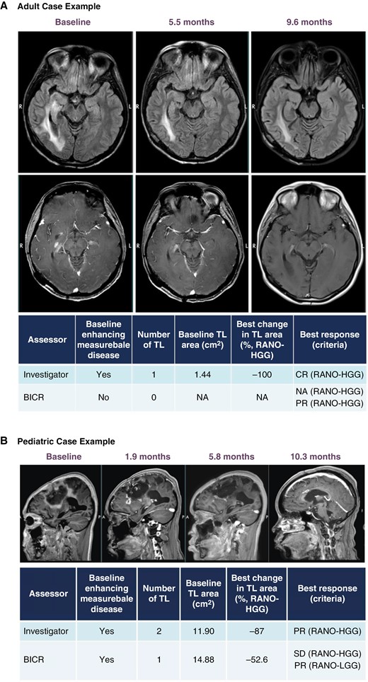 ONC201 responder case studies. Brain MRI over time shown for an adult case with complete response (A) and pediatric case with partial response* (B) treated with ONC201. *For the pediatric case (2B), the best change in TL area achieved >50% reduction necessary for PR; however, a new lesion at this timepoint detected by BICR resulted in an overall best response of SD by HGG-RANO. BICR = blinded independent central review; CR = complete response; HGG = high-grade glioma; LGG = neuro-oncology low-grade glioma; NA = not applicable; PR = partial response; RANO = response assessment for neuro-oncology; TL = target lesion.