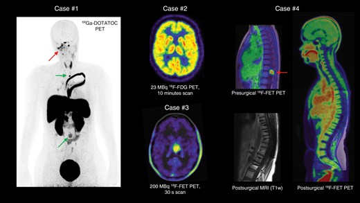 Illustrative imaging examples obtained by a long-axial field-of-view (LAFOV) PET/CT scanner displayed in maximum intensity projection.