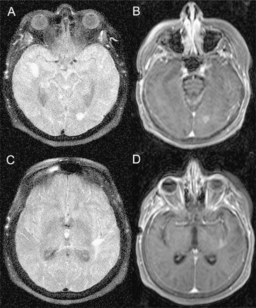 Distinctive MRI of patient 2. The initial scan after the onset of new symptoms showed contrast-enhancing lesions in each middle cerebellar peduncle. The prebiopsy scan demonstrates new contrast-enhancing lesions in the right and left temporal lobes, the left parietal, and the left occipital lobes. The figure displays the left occipital lobe lesion on fluid-attenuated inversion recovery (FLAIR) (A) and postgadolinium (B) images; and the left temporal lobe lesion on FLAIR (C) and postgadolinium (D) images.Note homogeneous and dense contrast enhancement. A scan 11 months after diagnosis and treatment with rituximab and cyclophosphamide showed only scattered T2 hyperintensities without contrast enhancement.