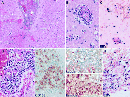 Characteristic features of Epstein-Barr virus (EBV)-associated polymorphous B-cell lymphoproliferative disorder observed in patient 2. There is evidence of a polymorphous infiltrate involving both leptomeninges (A, D) and parenchyma (B), with perivascular distribution. The infiltrate is composed predominantly of lymphocytes and plasma cells, as confirmed by the plasma cell marker CD138 (E). The kappa/lambda light chain stains displayed an excess of lambda light-chain-expressing plasma cells (F). The EBV in situ hybridization showed the presence of EBV-positive populations of lymphocytes and plasma cells both in parenchyma (C) and leptomeninges (H).