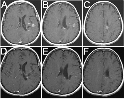 MRI response to antiangiogenic regimen: 64-year-old woman with recurrent anaplastic astrocytoma treated previously with surgery, radiation therapy, temozolomide, PCV (procarbazine, chloroethyl cyclohexylnitrosourea, and vincristine), CCI-779 (temsirolimus), and fenretinide before (A, B, C) and six months after (D, E, F) treatment with antiangiogenic chemotherapy. All images are axial T1-weighted postgadolinium images.