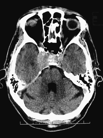Contrast-enhanced Ct reveals a right sellar and parasellar mass. Calcification is seen in the lesion.