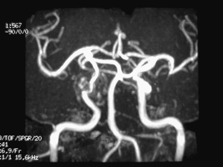 Axial contrast MRI shows a right sellar and parasellar mass (A). Coronal contrast MRI identifies optic nerve compression (B). MR angiography shows narrowing of the intracavernous carotid artery (C).