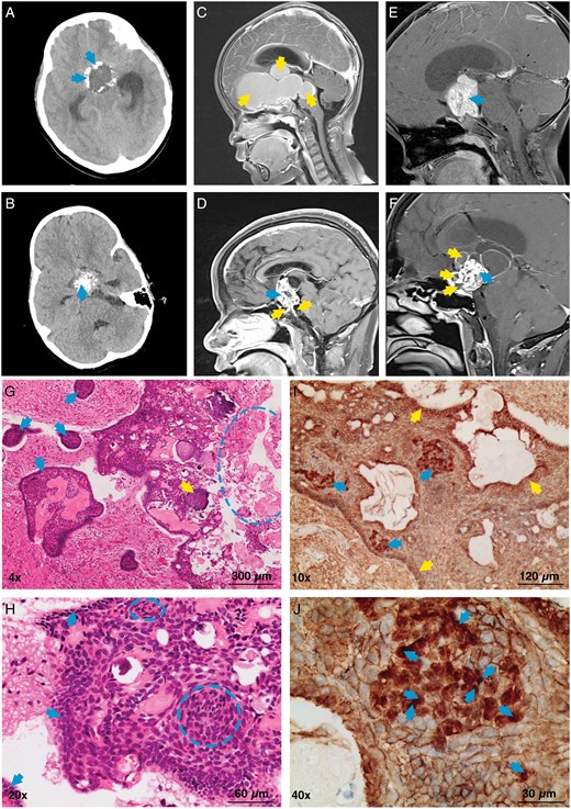 A series of medical imaging and histological staining images related to ACPs. (A) CT scan showing egg-shell calcification of the ACP, with arrows indicating the calcified region. (B) CT scan showing cluster-like calcification of the ACP, with an arrow marking the site. (C) MRI sagittal T1 image with contrast enhancement showing a completely cystic ACP lesion, with arrows indicating the cystic region. (D) MRI sagittal T1 image with contrast enhancement showing a mixed cystic and solid ACP lesion; an arrow points to the solid lesion in the upper left, and two arrows indicate the cystic lesion in the lower region. (E) MRI sagittal T1 image with contrast enhancement showing a solid ACP lesion, marked by an arrow. (F) MRI sagittal T1 image with contrast enhancement showing a mixed cystic and solid ACP lesion; an arrow points to the solid lesion on the right, while three arrows indicate the cystic lesion on the left. (G) HE staining of an ACP sample showing tumor papillary projections (marked by four arrows on the left), wet keratin (indicated by a circle), and calcification (marked by an arrow near the left side of the circle). (H) HE staining showing the tumor basal layer (indicated by three arrows on the left) and clusters of tumor cells (marked by a circle). (I) IHC staining showing β-catenin expression in the nuclei and cytoplasm of some tumor cells within tumor cell clusters (marked by three arrows on the left); the remaining tumor components predominantly show membranous expression, as indicated by arrows at the top, right, and bottom. (J) IHC staining showing β-catenin nuclear expression, indicated by an arrow.