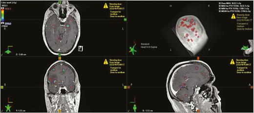 An example of a patient treated using single-isocenter multitarget radiosurgery for 30 brain lesions. The total volume of brain tumor (GTV total) is 4.7 cc. A 2–3 mm planning target volume (PTV) was used with 24 Gy prescribed to the PTV total and 27 Gy to the gross tumor volume total in 3 fractions. Treatment delivered with 5 volumetric modulated arc therapy arcs.