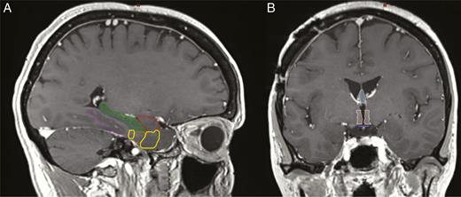 (A) Sagittal MRI demonstrating the anatomy of the medial temporal lobe structures: the amygdala (red), hippocampus (green), parahippocampal cortex (purple), perirhinal cortex (yellow), and the entorhinal cortex (orange). (B) Coronal MRI demonstrating the fornix (light blue), hypothalamus (light pink), and mammary bodies (dark blue).