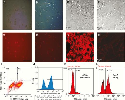 Administration of 5-ALA, to cell lines and in fluorescent-activated cell sorting (FACS): (A and C) U251 GBM cells imaged with bright field microscopy (A) and fluorescence microscopy after administration of 5-ALA (C) showing fluorescence in the vast majority of cells (scale bar 50 μm). (B and D) GIN17 primary low-passage GBM cells imaged with bright field microscopy (B) and fluorescence microscopy (D) after administration of 5-ALA with near-universal fluorescence (scale bar 50 μm). (E–H) Bright-field (E and F) and fluorescence (G and H) microscopy of human neural cell stem cells in an undifferentiated state (E and G) and after differentiation to astrocytes (F and H) with significantly reduced 5-ALA-induced fluorescence in their differentiated state. (I and J) FACS profile of a 50:50 mixture of 5-ALA-treated/untreated U251 cells demonstrating clear separation of unexposed cells (left-hand peak) from cells exposed to 5-ALA (right-hand peak). (K and L) Primary tumor specimens from patients undergoing isolation for 5-ALA fluorescence positive tumor cells, demonstrating first stage enrichment, followed by purification on the second sort.