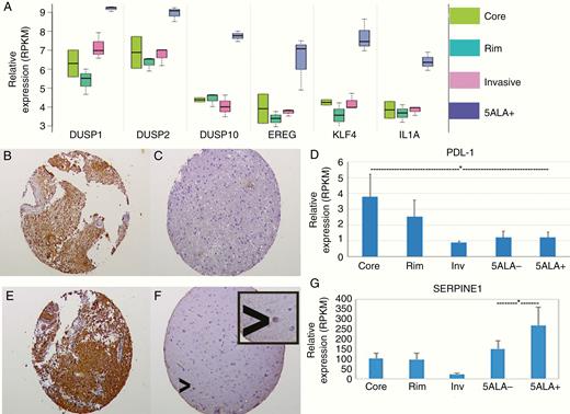 Expression levels of genes and proteins of interest in tumor and FACS isolated samples. (A) Expression profiles across tumor regions and in 5-ALA-positive cells for selected genes demonstrating expression patterns varying in the unsorted invasive region and particularly in 5-ALA-positive cells isolated by FACS. (B and C) Immunohistochemistry for VEGFA (×40 images) for a core (B) and invasive area (C) from the same GBM demonstrating representative high and low expression of VEGFA, respectively. (D) RNAseq expression profiles for the PDL1 immune checkpoint molecule, showing high PDL1 expression in the tumor core and low expression in 5-ALA-positive invasive cells (t-test P < .05, indicated by an asterisk). (E and F) Immunohistochemistry for SERPINE1 images (×40 images) showing high SERPINE1 expression in the tumor core (E) and overall low expression in the invasive zone (F); occasional positive cells in the invasive region (arrowhead) are hypothesized to be invasive GBM cells (magnified view of individual positive cell as an insert). (G) Expression levels on RNAseq of SERPINE1 in the unsorted core, rim, and invasive tumor areas and 5-ALA-positive and negative invasive cells, with elevated expression in the 5-ALA-positive FACS isolated population (significance compared to 5-ALA-negative cells t-test P = .014, indicated by an asterisk).