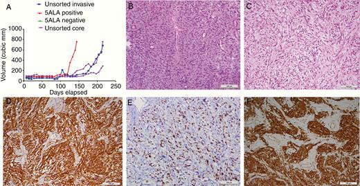 In vivo growth and immunohistochemistry. (A) Relative growth rates over time since the implantation of mixed unsorted (invasive margin or tumor core) cell xenografts (blue and purple lines), 5-ALA/FACS-negative cells (with no measurable tumor after day 20, green lines), and 5-ALA/FACS-positive invasive cells (red line), showing no growth for 5-ALA/FACS-negative cells and quicker growth for 5-ALA/FACS positive compared to unsorted mixed cells. (B) H&E of patient GBM (×40) from which a 5-ALA/FACS-positive xenograft was derived. (C) H&E of a flank xenograft in mouse, demonstrating GBM-like morphology. (D) Positive GFAP (astrocytic marker) IHC for mouse 5-ALA/FACS-positive GBM xenograft. (E) Positive IHC for Ki67 (proliferative marker) for mouse flank 5-ALA/FACS-positive GBM xenograft. (F) Positive IHC for vimentin (mesenchymal marker) in mouse 5-ALA/FACS-positive GBM xenograft (all scale bars 100 μm).