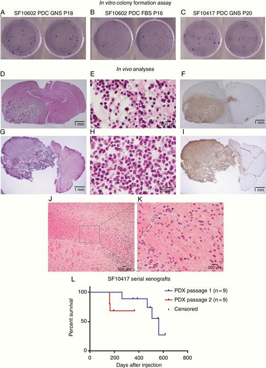 PDCs demonstrate tumorigenic properties in vitro and in vivo. To measure in vitro tumorigenesis, 1000 cells each of (A) astrocytoma SF10602 PDC GNS, (B) SF10602 PDC FBS, and (C) oligodendroglioma SF10417 PDC GNS were seeded into soft agar. After 4 weeks, they were stained with crystal violet and yielded an average of 185, 117, and 218 colonies, respectively. (D–L) To measure in vivo tumorigenesis, 300 000 cells were implanted into the right cerebrum of 5-week-old female athymic mice. (D) H&E staining of a coronal section of the mouse brain demonstrating the infiltrative nature of the tumor. (E) The tumor recapitulates oligodendroglioma histologic features and (F) is positive for IDH1 R132H by IHC. A cell line was established from this tumor and re-implanted in 5-week-old female athymic mice, where (G) it again formed infiltrative tumors that (H) recapitulate oligodendroglioma histology and (I) are positive for IDH1 R132H by IHC. (J) Tumor cells infiltrated from the site of injection in the striatum into and within the corpus callosum, (K) as single cells and as clusters of tumor cells (arrows) along blood vessels. (L) Upon the first xenotransplantation, SF10417 PDC GNS formed tumors in 4 of 9 mice over a protracted time period, consistent with the generally slower growth of this tumor subtype. Upon serial xenotransplantation, SF10417 PDX-PDC GNS formed tumors in 3 of 9 mice in a reduced time period. Tick marks indicate censored animals.