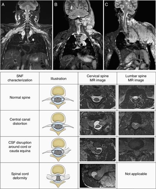 Spinal neurofibroma (SNF) burden characterization. Coronal short T1 inversion recovery MR images demonstrate the SNF distribution: multilevel symmetrical (A), multilevel predominantly one-sided (B), or single spinal nerve root (C). In addition to SNF, extensive plexiform neurofibroma (PN) is seen in the same body region in all 3 patients. The chart below illustrates our method of capturing the presence or absence of SNF-related spinal canal distortion, cerebrospinal fluid (CSF) disruption around the cord or cauda equina, and spinal cord deformity.