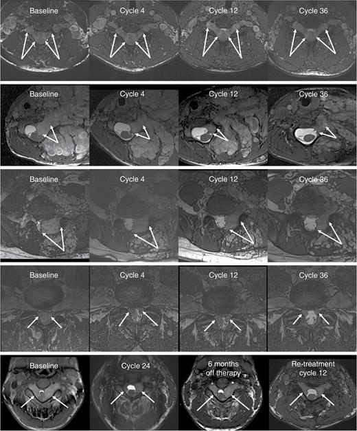 MRI examples of subtle (top row) and marked improvement (rows 2–5) in patients with spinal neurofibroma (SNF) receiving selumetinib therapy. The area of the spinal canal is shown on axial balanced fast field echo sequences. Arrows indicate the SNFs of interest. First row: Bilateral dumbbell tumors compress the spinal cord at the cervical 5–6 level. There is a slight gradual improvement in the narrow wedge shape of the cord and an increase in cerebrospinal fluid (CSF) abundance. Also note the decreasing size of the adjacent brachial plexus plexiform neurofibroma (PN). Second row: SNF in the left cervical 6–7 neuroforamen extends into the central canal and deforms the spinal cord. The size of the mass is markedly reduced after 4 cycles of selumetinib therapy with further improvement through cycle 36. Third row: SNF below the level of the cord (L5-S1) displacing the thecal sac and nerve roots. SNF shrinkage is apparent by cycle 4 and the response is maintained through cycle 36. Fourth row: Lumbar 4–5 level bilateral SNFs completely fill the central canal at baseline. CSF becomes detectable around the nerve roots after 4 treatment cycles and the improvement continues through cycle 30. Fifth row: The spinal cord deformity at C3-4 level is reduced during 24 cycles of therapy. Interruption of selumetinib treatment for 6 months resulted in SNF regrowth; however, improvement is evident again upon retreatment with selumetinib.