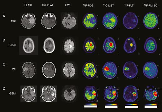 MRI (FLAIR, Gd-T1WI, and DWI) and PET images (18F-FDG, 11C-MET, 18F-FLT, and 18F-FMISO) in representative glioma patients. (A) A 29-year-old female patient in Mut subtype with the accumulation of 11C-MET and 18F-FLT. (B) A 38-year-old male patient in Codel subtype with high accumulation of 11C-MET, and slight accumulation of 18F-FLT. (C) A 58-year-old male patient in Wt subtype with the accumulation of 11C-MET and higher accumulation of 18F-FLT and 18F-FMISO than Mut. (D) A 69-year-old male patient with GBM with the highest accumulation of 11C-MET, 18F-FLT, and 18F-FMISO.