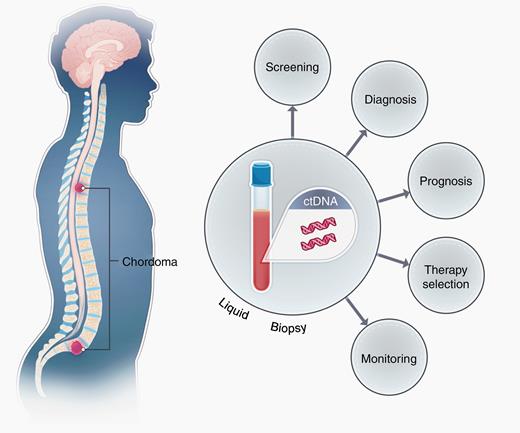 Schematic demonstrating the shedding of ctDNA derived from spinal chordomas in the plasma of patients. Chordomas shed DNA containing mutations into systemic circulation, allowing for non-invasive screening and recurrence monitoring by liquid biopsy techniques such as ddPCR and RACE-Seq. Prognostic and/or therapeutic information may also be imparted by liquid biopsy, depending on the nature of the mutation identified.