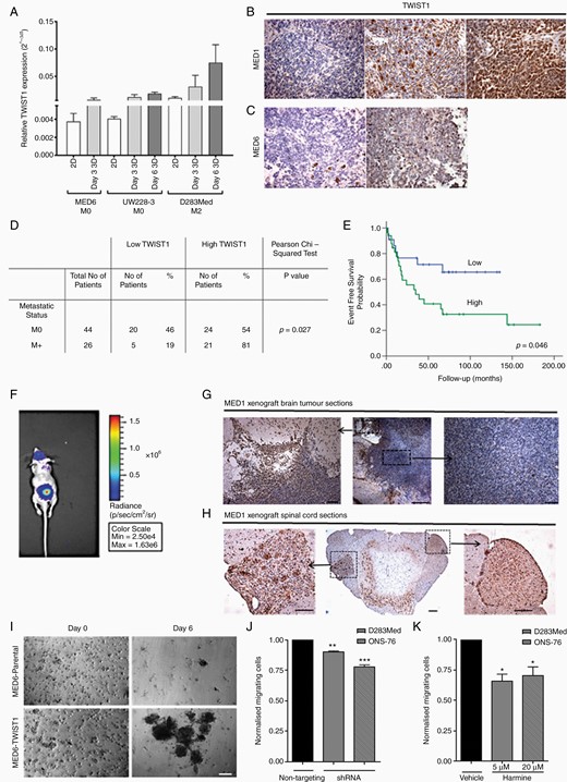 TWIST1 expression and functional analysis. (A) Relative gene expression of TWIST1 was assessed in 2D and 3D samples of 3 medulloblastoma cell lines and normalized against GAPDH using the 2−ΔCt method. (B) Representative images of nuclear TWIST1 IHC staining of MED1 and (C) MED6 patient tumor tissue at ×20 magnification (scale bars represent 50 µm). (D) Nuclear TWIST1 IHC staining of Nottingham and Birmingham TMA’s was scored and correlated with metastatic status (M0/M+) in 70 patients (>3 years old; Pearson’s chi-squared exact test; P = .027). (E) High TWIST1 expression correlated to adverse EFS in Kaplan–Meier curves of Nottingham and Birmingham TMA’s (Log-rank test; P = .046). (F) Bioluminescent images (obtained at 60 s exposure time) of brain and spinal cord tumors at 21 days after implanting MED1-Fluc cells into the mouse cerebellum. (G and H) Nuclear TWIST1 IHC staining of horizontal sections of the (G) brain and (H) right dorsal ganglia tumor of the spinal cord taken at ×4 and ×20 magnification (scale bars shown represent 50 µm). (I) MED6 and MED6-TWIST1 morphology with time-lapse images taken at ×10 magnification (scale bars represent 100 µm). (J and K) TWIST1 was inhibited in D283Med and ONS-76 cell lines using (J) shRNA or (K) Harmine (D283Med: 5 µM and ONS-76: 20 µM) for 72 h, before plating (1 × 105 cells/insert) onto a Collagen IV and Laminin coated transwell insert. Migrating cells were compared to either a non-targeting shRNA or DMSO control (paired Student’s t-test *P ≤ .05, **P ≤ .01; n ≥ 2).