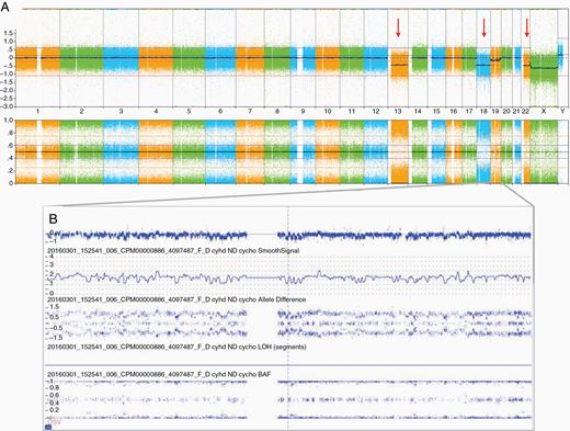 Copy number alterations in an anaplastic pleomorphic xanthoastrocytoma, WHO grade III, for a 5-year-old male patient (Patient 83, Case 91): (A) chromosomal microarray whole-genome view (from left to right: chromosomes 1–22 followed by X and Y) showed loss of chromosomes 13, 18, and 22 indicated by red arrows and (B) chromosome 19 chromothripsis.