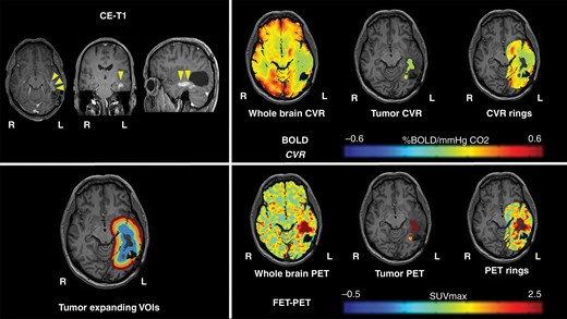 Representative imaging data of one patient with glioblastoma. A 52-year-old male patient with left-sided temporal glioblastoma (WHO grade IV) was diagnosed and macroscopically completely resected in February 2016. In November 2017, the patient presented with recurrent tumor temporal on the left side. He underwent a BOLD-CVR and PET study in a time frame of 6 days and before the microsurgical resection of the recurrent glioma. BOLD-CVR showed impaired CVR clearly beyond the tumor borders as seen in T1-contrast-enhanced images. FET-PET images showed hypermetabolism in the tumor area as well as in the first VOI. The histopathological examination has confirmed the diagnosis of recurrent WHO grade IV glioma.