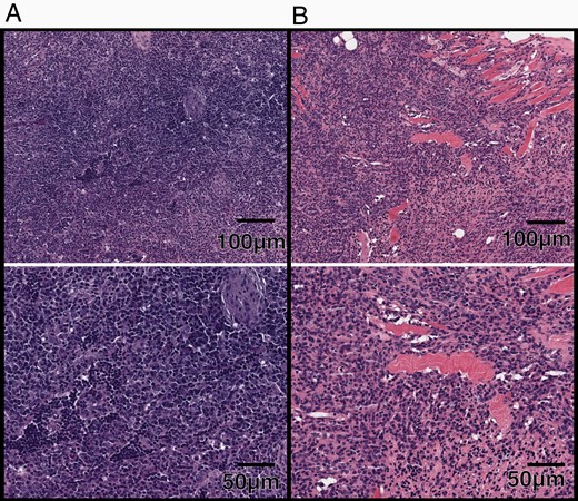 H&E-stained sections of masses developed outside of spinal irradiation field. (A) 10× (top) and 20× (bottom) magnification of a high-grade lymphoma. (B) 10× (top) and 20× (bottom) magnification of an ulcerated cutaneous neurofibroma. (C) 10× (top) and 20× (bottom) magnification of a follicular infundibular cyst. (D) 10× (top) and 20× (bottom) magnification of an undifferentiated malignant neoplasm entrapping the epididymis.