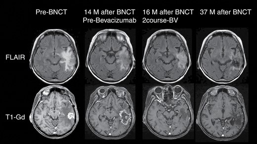 Representative case of this trial. A 63-year-old female patient underwent surgery for a left temporal tumor with GB histology. She was followed up with a standard of care comprising fractionated XRT and TMZ. Unfortunately, 14 months after craniotomy, recurrence was recognized on follow-up MRI. She then entered into this clinical trial and received BNCT. BNCT could control the mass 1 year after treatment, although brain swelling occurred subsequently because of radiation injury. After PD assessment, she was administered BEV periodically. Edema was well-controlled, and no re-aggravation was observed. The patient continues to do well, with stabilized neurological status in the 3 years following BNCT. Some MR images in this figure were obtained outside the scope of this clinical trial; informed consent was obtained for use in this report from the patient.
