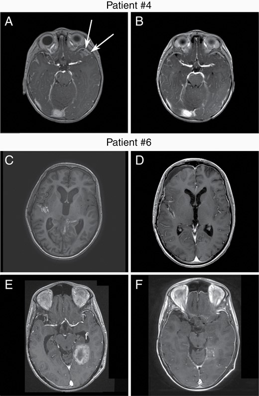 SMOi response evaluation by MRI T1 with contrast enhancement. Patient #4 baseline MRI before SMOi initiation. Contrast enhancement of a relapse in the temporal lobe (a) showing a very good partial response after 8 weeks of sonidegib (b). Patient #6 baseline MRI before SMOi initiation showing a metastatic relapse in the Silvius fissure (c). Partial response was achieved after 2 months of vismodegib (d). A Dramatic relapse occurred while treated by sonidegib, with new metastasis in the temporal lobe (e). Partial response was achieved gain 4 months later with a combination of sonidegib and temozolomide (f). Importantly, the patient had previously received temozolomide. MRI, magnetic resonance imaging; SMOi, smoothened inhibitor.