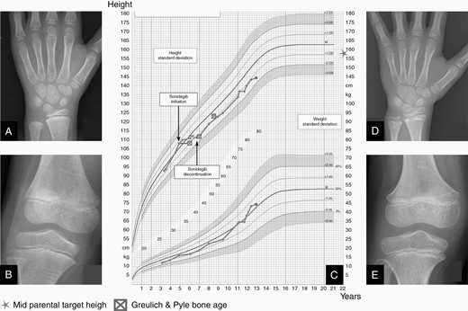 Patient #8 growth outcome. Patient #8’s Greulich and Pyle bone age (A) and knee X-rays (B) showing central epiphyseal fusion between sonidegib treatment baseline and 1 year after (D and E). Flattening of growth chart (C) from +0.5 SD to −1 SD during sonidegib treatment. After treatment withdrawal, growth velocity improved without recovering a normal growth.