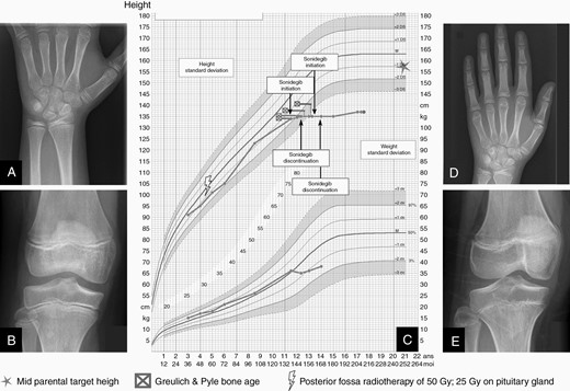 Patient #7 growth outcome. Patient #7’s Greulich and Pyle bone age (A) and knee X-rays (B) showing growth plate fusion between sonidegib treatment baseline and 1 year after with metaphyseal sclerosis (D and E). Flattening of growth chart (C) at sonidegib initiation with poor growth velocity at discontinuation. Her final height was 3 standard deviation below mid parent target height. To note, this patient had an ovarian dysfunction as a consequence of a high-dose chemotherapy that could impact her puberty.