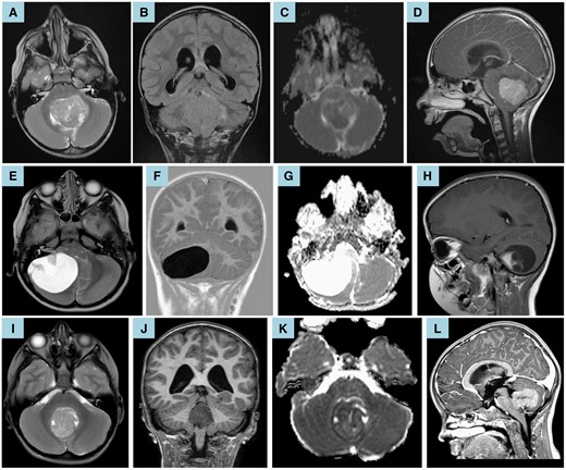 (A–D) Preoperative brain MRI of a 6.5-year-old boy showed a fourth ventricular medulloblastoma with corresponding restricted diffusion (C—apparent diffusion coefficient map). Axial T2-weighted MRI (A) and coronal T2-weighted-fluid-attenuated inversion recovery (B) show compression of the right middle cerebellar peduncle; infiltration of the cerebellar vermis, left cerebellar hemisphere, and left cerebellar peduncles; and compression of the right superior cerebellar peduncle. Sagittal T1-weighted postcontrast imaging (D) shows compression of the brainstem and midbrain. Moderate hydrocephalus is also noted (B, D). Given these anatomical and imaging characteristics, the ANN predicted that the patient would develop pCMS (likelihood 90.6%). Clinically, the child subsequently underwent gross total resection via a transvermian approach and manifested symptoms of pCMS in line with this prediction. (E–H) Preoperative brain MRI of a 4.5-year-old girl showed a large cystic lesion within the posterior fossa with high apparent diffusion coefficient values (G) and an enhancing mural nodule (H—sagittal T1-weighted postcontrast imaging). These imaging features are in keeping with a pilocytic astrocytoma. Axial T2-weighted MRI (E) and coronal T1-weighted inversion recovery (F) show infiltration of the right middle cerebellar peduncle and compression of the brainstem, vermis, fourth ventricle, and left cerebellar hemisphere. Mild hydrocephalus is also noted (F). Given these anatomical and imaging characteristics, the ANN predicted that the patient would not develop pCMS (likelihood 24.1%). Clinically, the child subsequently underwent gross total resection via a trans-cerebellar approach and did not manifest any symptoms of pCMS in line with this prediction. (I–L) Preoperative brain MRI of an 8-year-old girl showed a caudal intraventricular medulloblastoma with compression of the brainstem and cerebellar vermis (I—axial T2-weighted MRI), corresponding restricted diffusion (J—apparent diffusion coefficient map), and moderate hydrocephalus (K—coronal T1-weighted MRI; L—sagittal T1-weighted postcontrast imaging). Given these anatomical and imaging characteristics, the ANN predicted that the patient would not develop pCMS (likelihood 2.4%). Clinically, the child underwent gross total resection via a telovelar approach and did not manifest any symptoms of pCMS in line with this prediction.