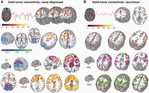 Solid tumor connectivity profile. (A) Seed-to-voxel analysis revealed significant glioma BOLD signal synchronization (ie, functional connectivity, FC) with bifrontal regions and occipital cortices in newly diagnosed patients (P < .05; n = 18), roughly overlapping with the known resting-state networks such as the FPCN, VAN and VS. (B) Seed-to-voxel analysis performed on patients at recurrence (n = 36) revealed significant FC between the tumor mass and bilateral fronto-parietal regions (P < .05), resembling the VAN and DAN RSNs. DAN, dorsal attention network; FPCN, fronto-parietal control network; VAN, ventral attention network; VS, visual network.