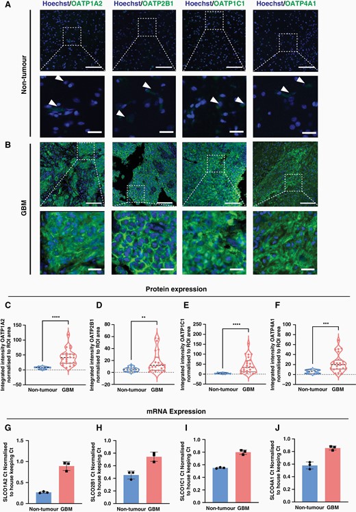 Tissue-wide integrated intensity analysis reveals an overexpression of OATP1A2, 2B1, 1C1 and 4A1 in GBM tissue. Representative immunohistochemical labelling of OATP1A2/OATP2B1/OATP1C1/OATP4A1, as labelled with Hoechst nuclear counterstain in non-tumour (A) and GBM (B) tissue; scale bar = 100 μm, inset = 75 μm. The mean integrated intensity of OATP1A2, 2B1, 1C1, and 4A1 was compared between GBM and non-tumour with a non-parametric Mann-Whitney test (C–F), data compared between tumour (n = 25 cases) and non-tumour (n = 8 cases) tissue with Mann-Whitney test, presented as violin plot, median ± upper and lower quartiles. qRT-PCR quantifying the mRNA expression of OATP1A2, 2B1, 1C1 and 4A1 in GBM tumour tissue compared to non-tumour MTG brain tissue (G–J), data represents the mean ± SD of GBM (n = 3 cases) and non-tumour (n = 3 cases) fresh-frozen cases. **P < 0.01, ***P < 0.001, ****P < 0.0001.