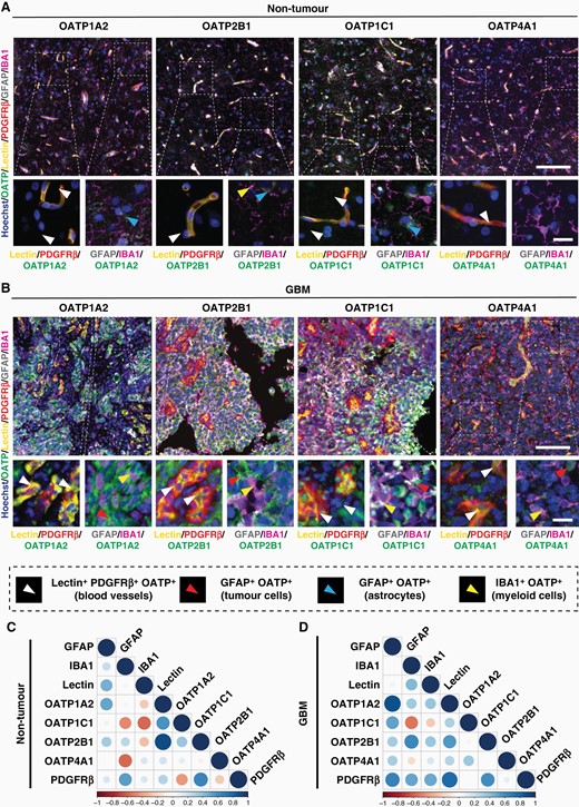Increased expression of OATP1A2, 2B1, 1C1 and 4A1 in GBM tissue across multiple cell types. Representative immunohistochemical labelling of OATP1A2/OATP2B1/OATP1C1/OATP4A1, as labelled with pan myeloid marker, IBA1; tumour cell/astrocyte marker, GFAP; endothelial cell marker, UAE-1 lectin; stromal cell marker, PDGFRβ; and Hoechst nuclear counterstain in non-tumour (A) and GBM (B) tissue; scale bar = 100 μm, inset= 20 μm. Manual cell population classification of blood vessels, tumour cells, astrocytes, and myeloid cells from cell-specific marker expression is defined in the figure key. OATP integrated intensity normalised to ROI area was correlated with cell-type specific markers to predict cell-type specific expression of OATPs in non-tumour (C) and GBM (D) tissue using Spearman correlations. Data presented as a matrix of correlation coefficients between markers; n = 8 cases (non-tumour), n = 25 cases (GBM).