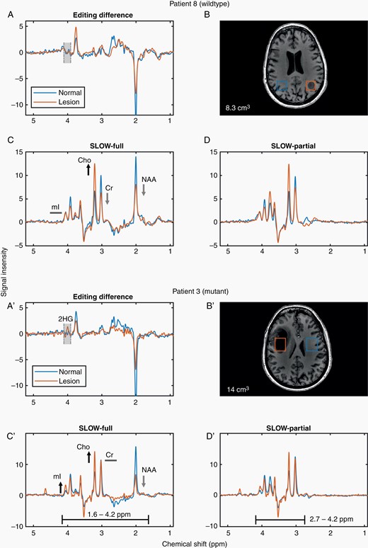SLOW-EPSI for 2 patients (IDH wildtype/mutant). (A, A′) Editing difference = SLOW-partial minus SLOW-full. (B, B′) The corresponding MRI and displaced volume (7.6 cm3 in B and 14 cm3 in B′. (C, C′) SLOW-full acquisition. (D, D′) SLOW-partial acquisition.