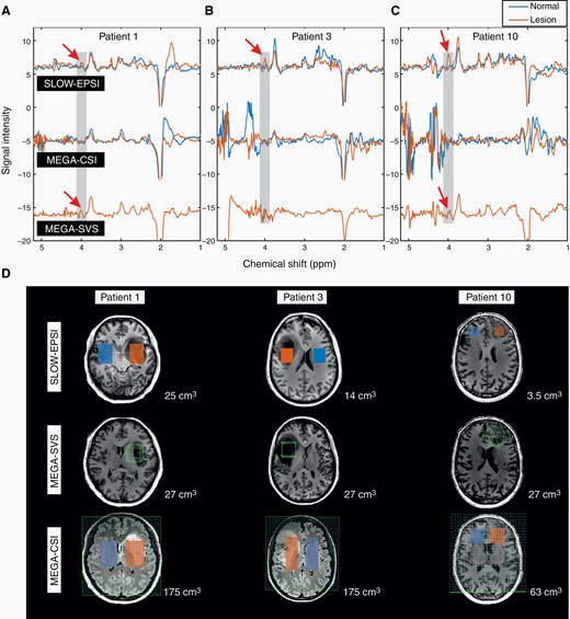 (A–C) The in vivo spectral editing difference (editing-partial minus editing-full for SLOW-editing, editing-on minus editing-off for MEGA-editing) within lesion/tumor (orange line) and mirror-symmetric normal tissue (blue line). The red arrows indicate the 2HG signals. (D) The MRI and corresponding MRSI/MRS volume-of-interest of 3 patients. The displaced volumes are indicated as orange (lesion) and blue (normal tissue) rectangular for SLOW-EPSI and MEGA-CSI. The size of the displaced volume is as indicated.