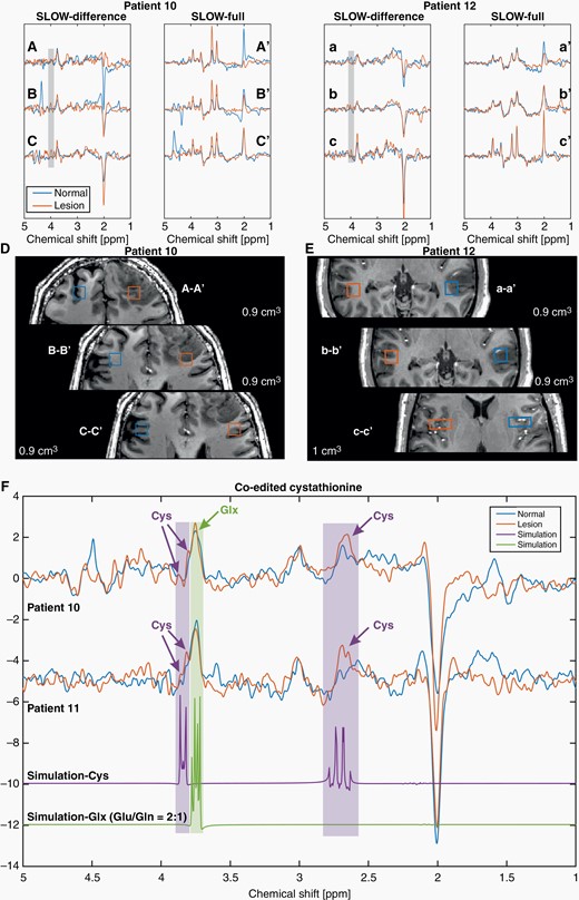 SLOW-EPSI for patients #10, 11, and 12. (A–C, a–c) Editing difference spectrum for 3 different locations, inside, around and outside the tumor in patients #10 and 12. (A′–C′, a′–c′) Corresponding SLOW-full spectrum. (D–E) Corresponding selected volume and MRI. (F) The cystathionine peaks (orange) are shown and indicated by purple arrows at 2.7 and 3.85 ppm in patients #10 and 11, respectively. Note that the selected volumes were not shown in the MRI. The simulations of cystathionine (purple) and Glx (glutamate/glutamine = 2:1, green) are shown.
