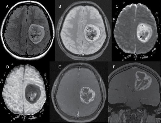 Preoperative images. (A) Axial FLAIR image shows 5 cm mass centered in the left centrum semiovale and corona radiata with surrounding minimal vasogenic edema. (B) On T2 GRE, there is central susceptibility compatible with internal hemorrhage. (C) On diffusion weighted image, the peripheral components show mostly isointense signal with increased signal in the lateral margin. Internal heterogeneity, likely due to internal blood products. (D) ADC map shows corresponding bright signal in the peripheral regions with dark signal in the lateral margin, suggestive of facilitated diffusion and low cellularity mostly with relative diffusion restriction in the lateral margin. Heterogeneous signal at the center was due to blood products. Fat-saturated contrast enhanced axial (E) and coronal (F) images show avid thick enhancement in the peripheral solid component with irregular lobulated contours and bell-pepper like appearance. Overall, MRI features are suggestive of an aggressive high-grade glial tumor except the diffusion weighted images, demonstrating facilitated diffusion in the most of the solid peripheral components with small focal diffusion restriction in the lateral margin.