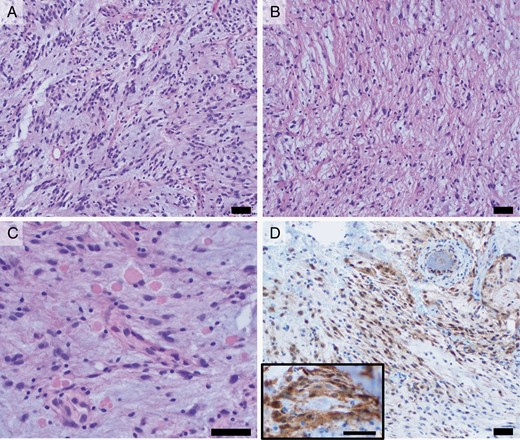 (H&E, 200×) Histologic sections show a predominant component with often elongated tumor cells with occasional bipolar cytoplasmic processes in a myxoid background (A), in addition to a more solid, fibrillary component (B). C. (H&E, 400×) Both components showed frequent eosinophilic granular bodies. D. (pERK, 200×) Increased cytoplasmic and nuclear immunohistochemical staining for pERK is seen in tumor cells, indicative of MAPK pathway activation. Staining is comparable to that seen in a separate example of pilocytic astrocytoma with KIAA1549::BRAF fusion provided for reference (inset, 400×). Scale bars = 50 µm.