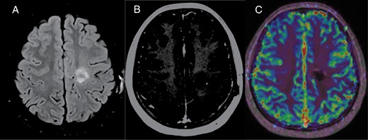 Postoperative 4-month follow-up MRI. (A) Axial FLAIR shows hyperintense proteinaceous fluid containing resection cavity without any surrounding vasogenic edema. Mild expected gliosis surrounding the resection cavity. (B) Contrast enhanced axial T1-MPRAGE shows no significant worrisome enhancement. Minimal marginal enhancement expected in the postoperative stage. (C) Axial fused DSC perfusion image in a different slice shows lack of increased perfusion even in marginal thin enhancing areas, suggestive of gross total resection with post-operative changes.