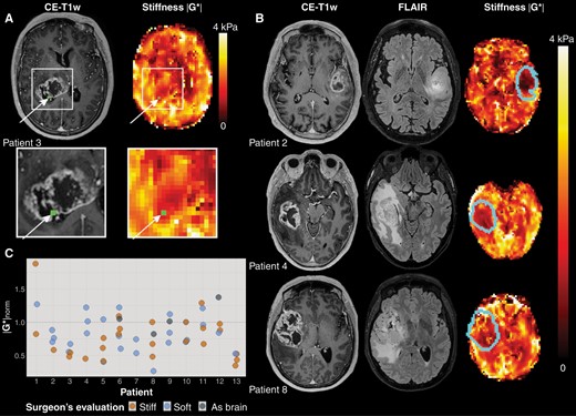 (A)Example of MRE imaging. The location of the tissue biopsy is shown in green in the contrast-enhanced T1-weighted image (CE-T1w) and the MRE stiffness map (|G*|). (B) Representative images for three patients. From left to right: CE-T1w images, and |G*| map, with tumor outline overlaid. (C) Stiffness measurements for all biopsies per patient (n = 56). Normalized MRE-based stiffness |G*|norm for all biopsies acquired for all patients (n = 13). The median normalized stiffness for biopsies evaluated by the surgeon as stiff was 0.71, with 0.79 for biopsies evaluated as soft. Biopsies found by the surgeon to be similar in consistency to healthy brain tissue had a median normalized stiffness of 1.03. The horizontal line at |G*|norm = 1 shows the mean stiffness in each patient’s contralateral normal-appearing white matter.