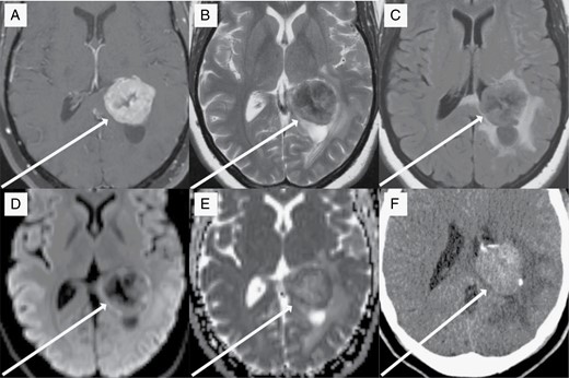 37-year-old woman with intraventricular intracranial mesenchymal tumor. T1-postcontrast imaging (a) reveals a strongly enhancing lobulated mass within the atrium of the left lateral ventricle. There is a central region of nonenhancing tumor that is more hypointense on T2-weighted imaging (b) compared to the periphery of the tumor. T2-FLAIR imaging (c) reveals moderate surrounding vasogenic edema within the surrounding brain parenchyma. Diffusion-weighted imaging (d) shows hyperintensity in the periphery of the tumor, which, along with the hypointensity seen on apparent diffusion coefficient imaging (e), represents decreased diffusivity and is suggestive of a high cellularity. A noncontrast CT study (f) shows that the tumor is hyperdense compared to normal brain parenchyma and contains course areas of calcification.