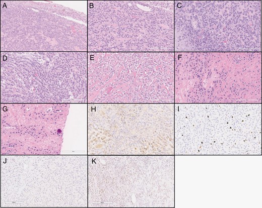 Histologic features of the tumor. (a) Tumor with good demarcation from the adjacent brain tissue. (b–c) Tumor cells arranged in trabecular/sheet-like pattern. (d) Epithelioid tumor cells organized in cords. (e) Epithelioid, almost clear cell morphology of tumor cells infiltrating fibrous stroma. (f) Tumor cells are dispersed as single-file-like cords in the dense stroma. (g) Fibrous stroma and infiltrating tumor cells in single cell appearance resembling carcinoma and focal calcification. (h) EMA expression in tumor cells. (i) Ki-67 index, quantitated as 11.7% by automated analysis. (j) No nuclear staining detected with STAT6. (k) Focal progesterone receptor (PR) expression was noted.