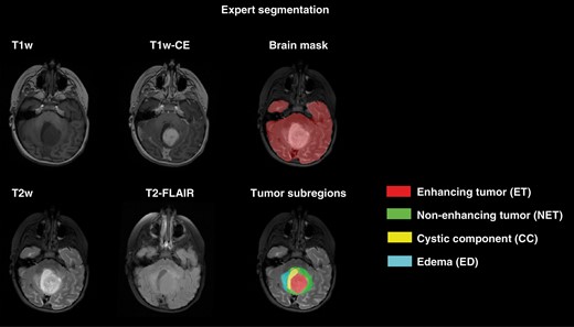Expert segmentation on a sample patient illustrating how brain tissue and tumor subregions were segmented.
