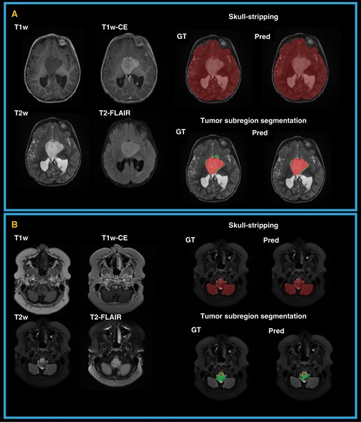 Examples of predicted (Pred) and expert or ground truth (GT) segmentations for skull-stripping and tumor subregions in two patients. (A) a 2-year-old female with a hypothalamic low-grade astrocytoma; (B) an 18-year-old female with low-grade astrocytoma in medulla.