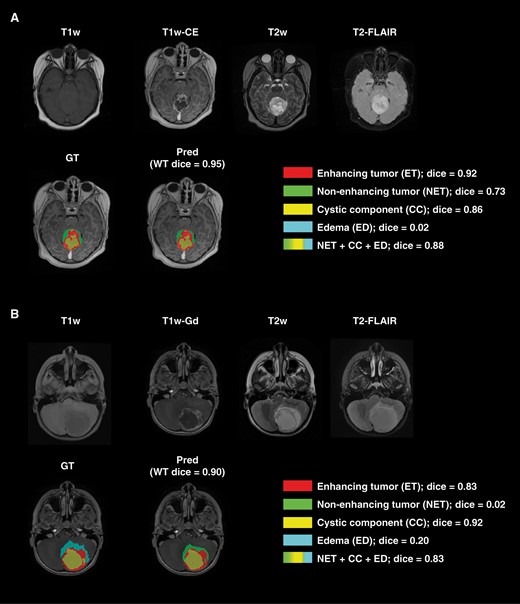 Examples of two subjects with accurate whole tumor, enhancing tumor, and non-enhancing component/edema (combination of non-enhancing tumor, edema, and cystic component) but with low Dice scores on the non-enhancing tumor and edema subregions.