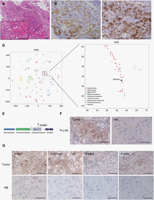 Histopathological, genomic, and epigenomic analysis. (A) Hematoxylin and eosin staining. Bars, 100 μm. (B, C) Immunostaining for c-kit (B) and D2-40 (C). Bars, 100 μm. (D) Unsupervised clustering using t-SNE analysis by using DNA methylation data. (E) A scheme of the KIT gene and single nucleotide variant in this tumor. (F, G) Immunohistochemistry for indicated proteins. NB, normal brain. Bars, 50 μm.