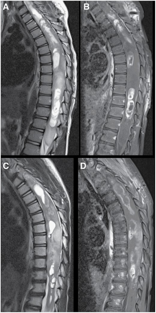 Changes following treatment of spinal cord tumor. Preoperative sagittal T2-weighted (A) and post-contrast T1-weighted (B) MR images of the thoracic spine demonstrating a large cystic-solid intramedullary spinal cord tumor with expansion of the spinal cord and multiple areas of contrast enhancement. Following treatment, repeat T2-weighted (C) and post-contrast T1-weighted (D) MR imaging showed a decrease in the enhancing portions as well as the cystic areas of the tumor. Expansion of the distal spinal cord and conus medullaris also decreased.