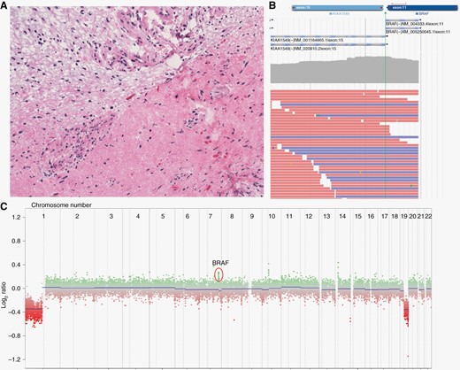 Histologic appearance and molecular profiling of the tumor. Hematoxylin and eosin stain of the excised neoplasm at 200× final magnification (A). The stain demonstrates a biphasic pattern, classic of pilocytic astrocytoma, with a compact component with numerous Rosenthal fibers in the right corner. The interface between the 2 components shows prominent vascularity. Next-generation sequencing identified a KIAA1549-BRAF fusion (B) as well as 1p/19q codeletion and gain of partial 7q (C).
